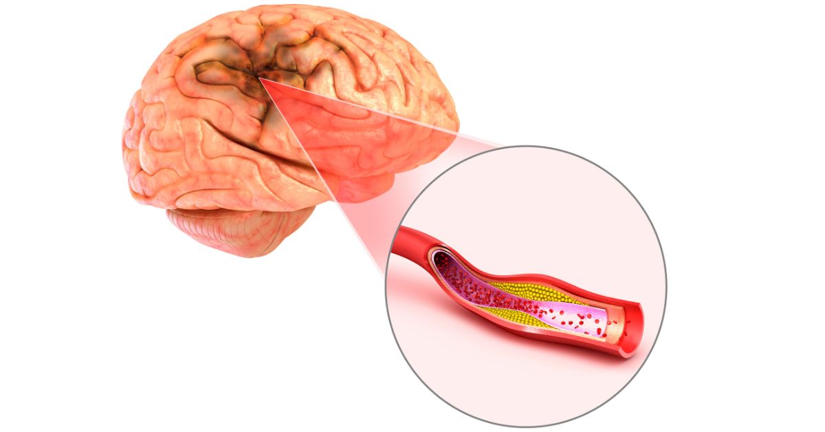 What causes blood clots in the brain?