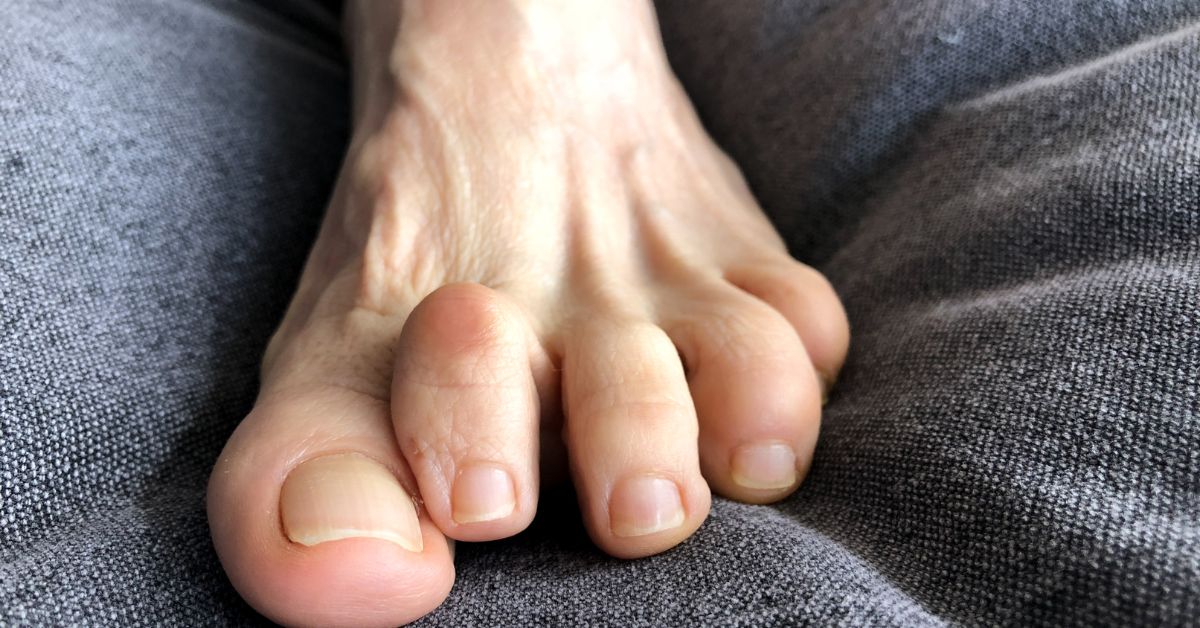 Hammer Toe or Mallet Toe, Causes, Signs and Symptoms, Diagnosis and  Treatment. 