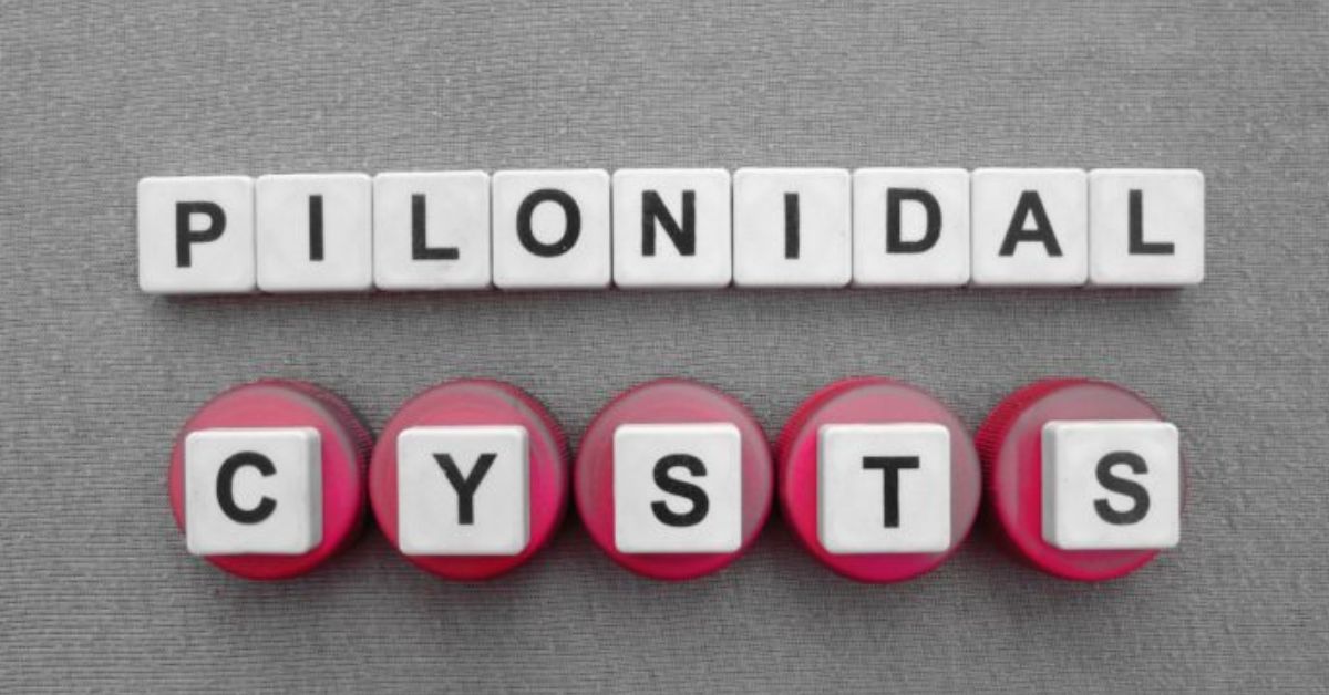 Pilonidal Cysts Overview: Symptoms, Diagnosis, & Treatments