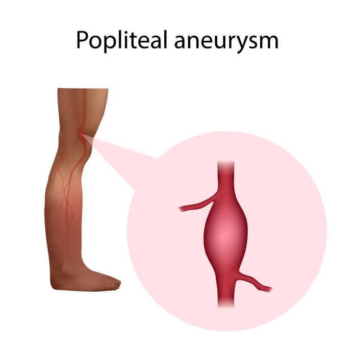 Popliteal Artery Aneurysm