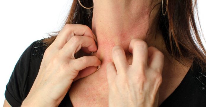 Cholinergic Urticaria: Causes, Symptoms, Treatment and Prevention