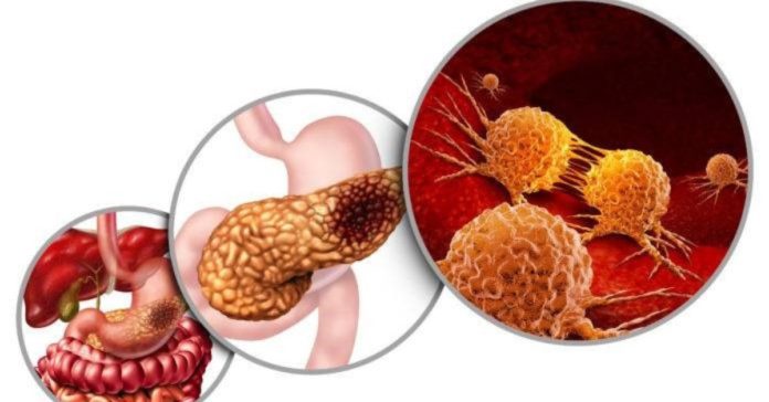 Pancreatic Cancer and Its Symptoms Introduction