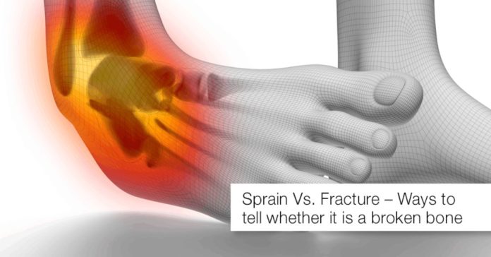 Sprain Vs. Fracture – Ways to tell whether it is a broken bone