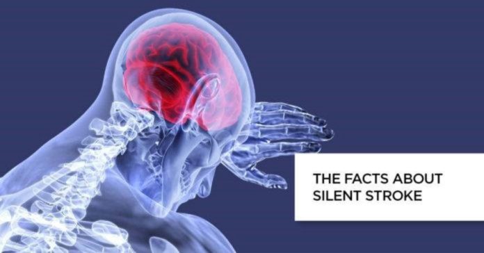 The Facts about Silent Stroke