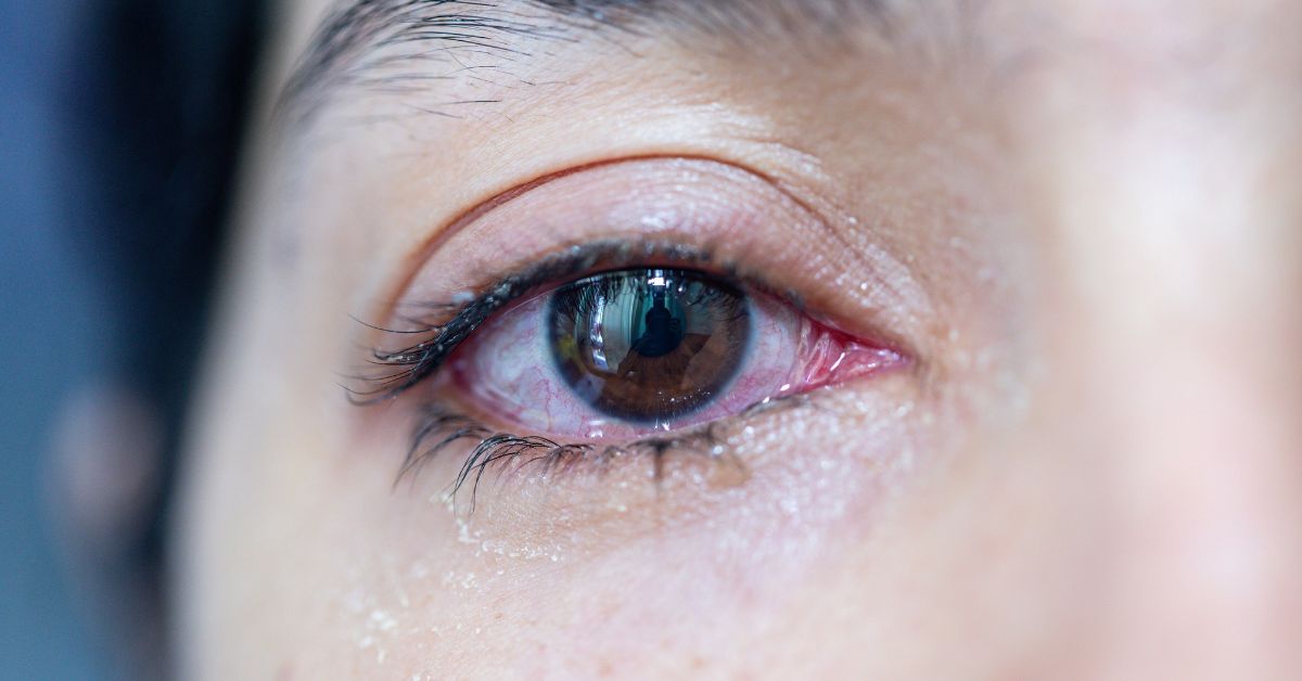 Watery Eyes: Causes, Treatment, and More