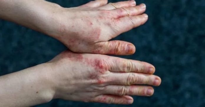 What is Dyshidrotic Eczema & What are its Symptoms
