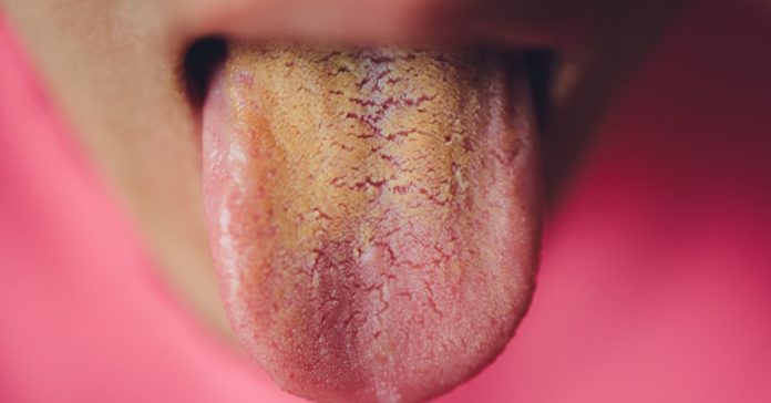 Yellow Tongue: Causes, Symptoms, Treatment, Diagnosis, Prevention