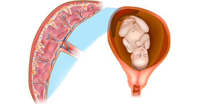 Placental Insufficiency