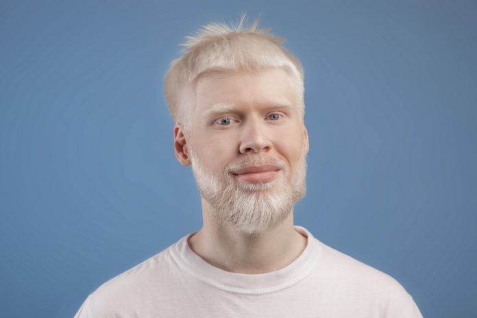 Albinism: Types, Causes, Symptoms and Treatment