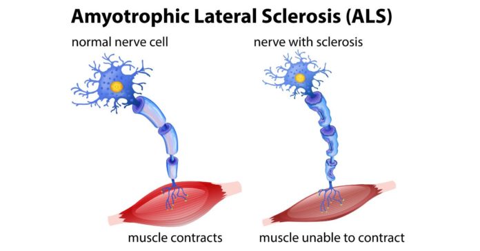Amyotrophic Lateral Sclerosis (ALS): Types, Causes, Symptoms and Treatment