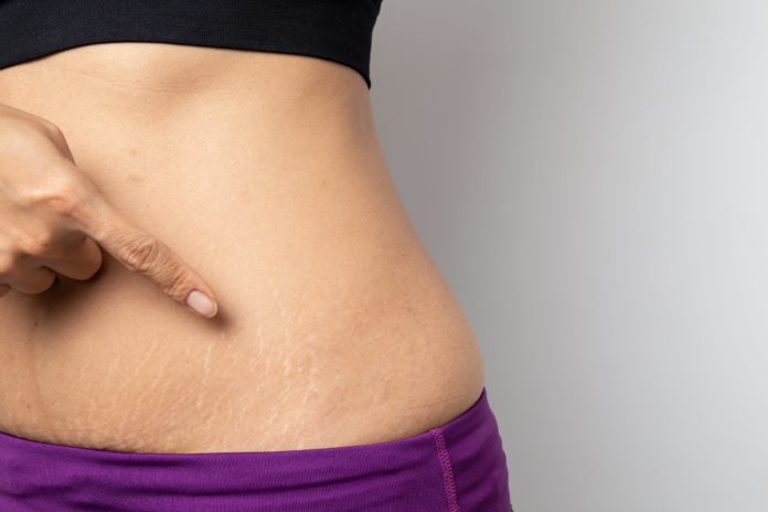 Stretch Marks: During and After Pregnancy, and What to Expect