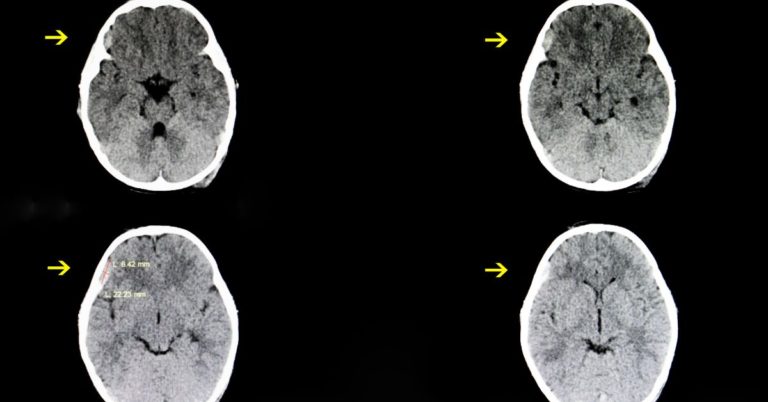 Subdural Hematoma Types Symptoms Causes Treatment Diagnosis