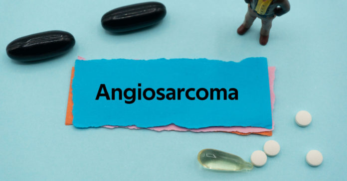 Angiosarcoma : Symptoms, Causes, Diagnosis, Treatment and Prevention