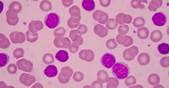 Acute myeloid leukemia (AML): Symptoms, Causes and Treatment