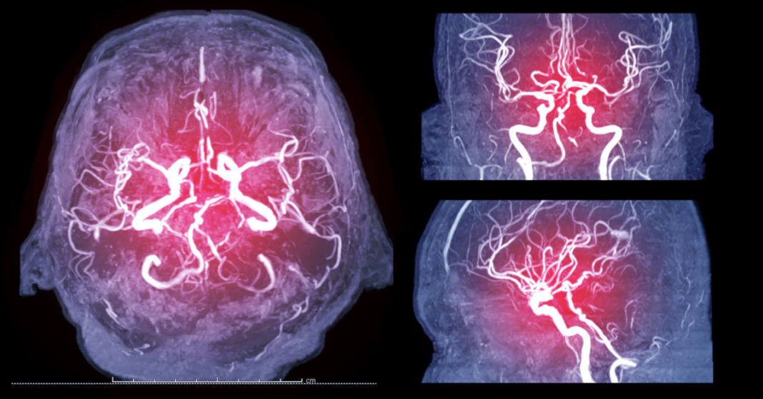 Cerebral Angiogram Why Is It Prescribed Procedure And Preparation